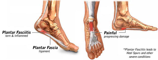 indianapolis chiropractor plantar fasciitis